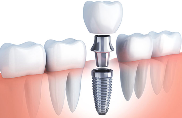 Dental Implants in Akurdi and Moshi – Restore Your Smile