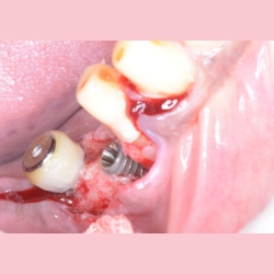 Bone Grafting for Dental Implants