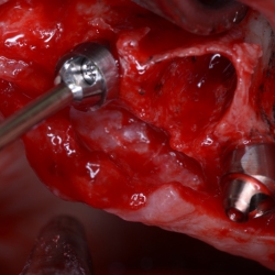 Customized Dental Implant Treatment Plan in PCMC