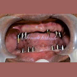 dental implant abutment in place