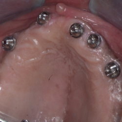 Dental Implant Abutment Placement in PCMC