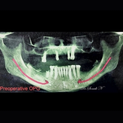 Dental Implant Consultation in PCMC