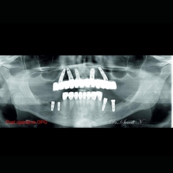 Dental Implant Crown Placement