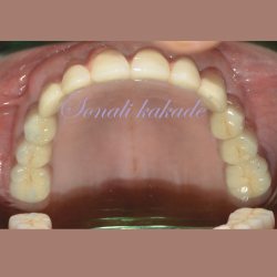 dental implant fixture with prosthesis