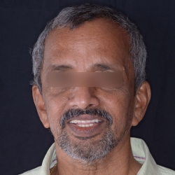 Dental Implant Follow up Maintenance in PCMC