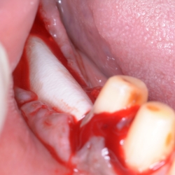 Dental Implant Placement Surgery in PCMC Expert Oral Care
