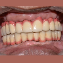 fixture with prosthesis step 10 of implant process