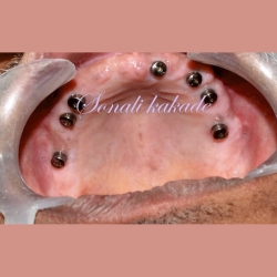 healing abutment for dental implant