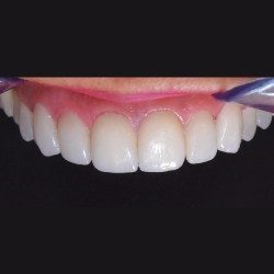 healing abutment placement step 14 of implant process