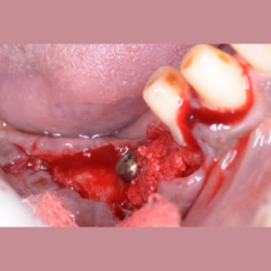 Healing After Bone Grafting Implant Preparation in PCMC