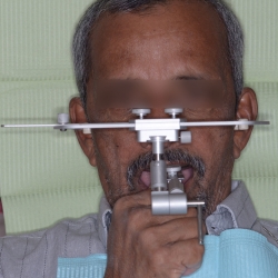 Healing After Dental Abutment Placement PCMC Care