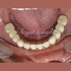 implant fixture and prosthesis