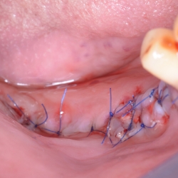 Osseointegration Implant Healing Process in PCMC