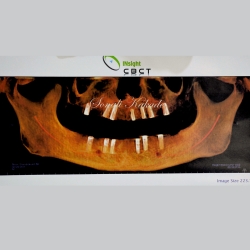 post operative dental implant scan