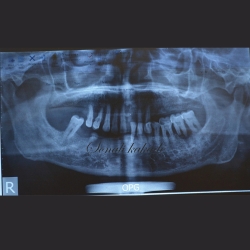 pre operative opg for dental implant