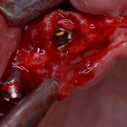 Tooth Extraction Before Dental Implants