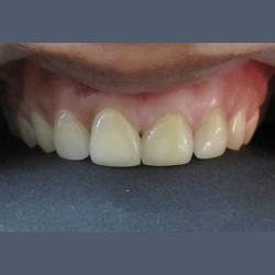 definitive cementation of dental restoration