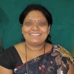 extra oral front view of dental transformation