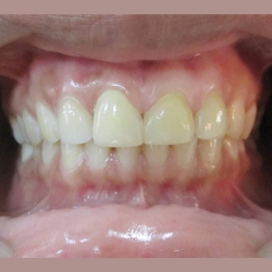 frontal view in occlusion of dental procedure