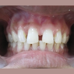 intra oral frontal view of dental procedure