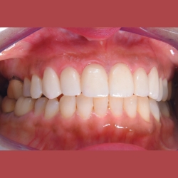 laminates in pcmc 6 step cosmetic dental solution