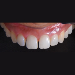 simple process dental laminates in nigdi
