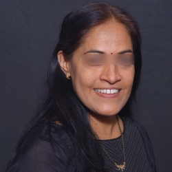 the smile makeover dental laminates in akurdi and chinchwad