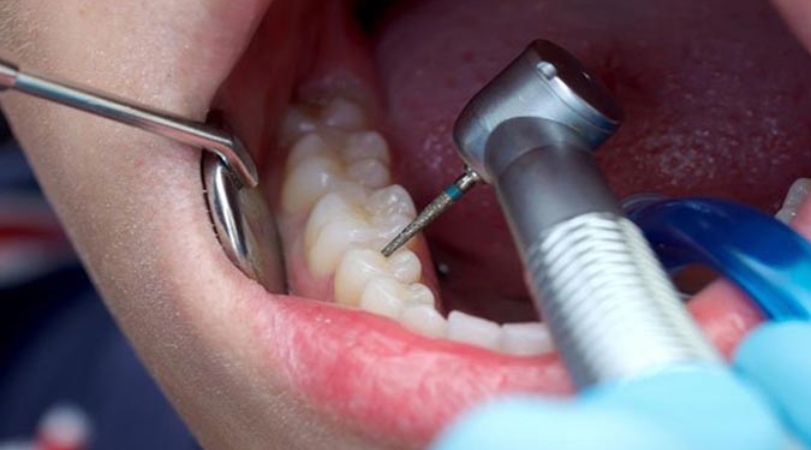 Root Canal Treatment in Akurdi – Pain-Free Dental Care