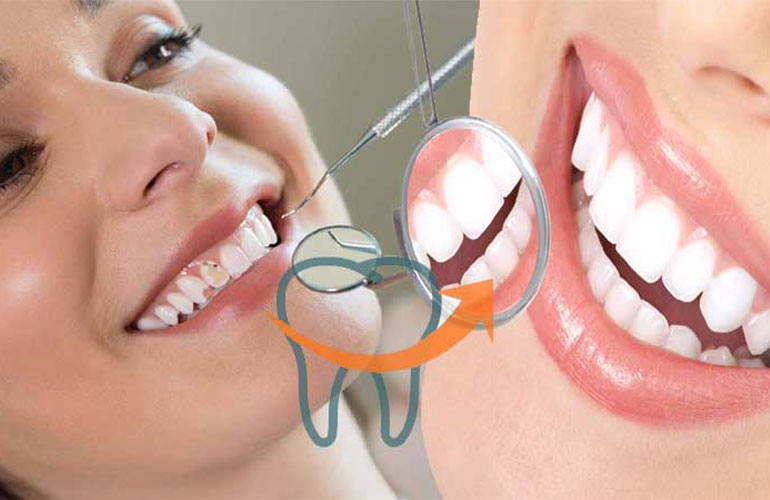 Smile Designing in Ravet and Pradhikaran – Cosmetic Dentistry Experts