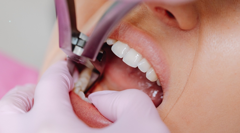 Tooth Extraction in Pimpri – Safe & Comfortable Procedures